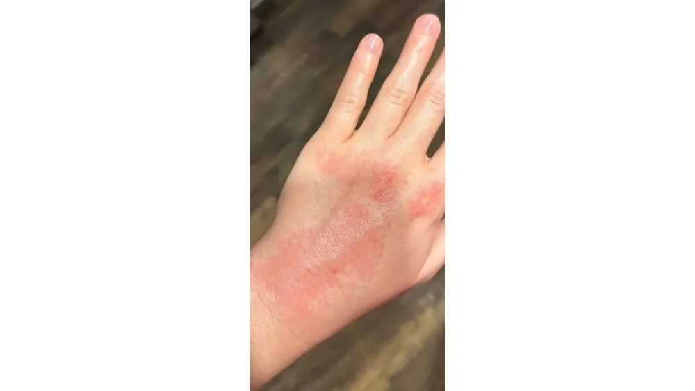 Hand Infections — before