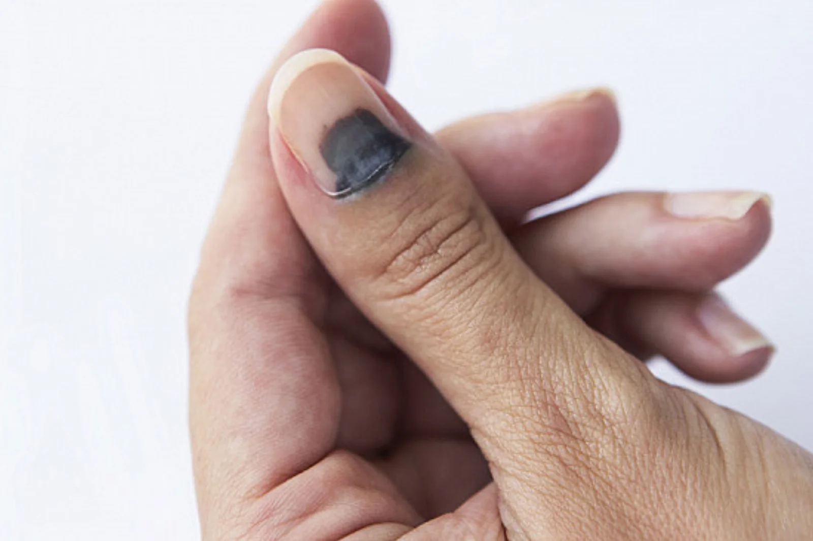 Nail Deformities — hero image