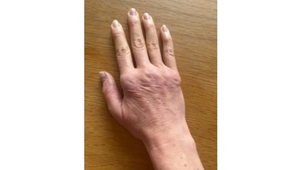 After surgery