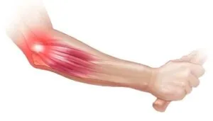 Tennis Elbow