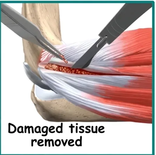 Understanding Tennis Elbow
