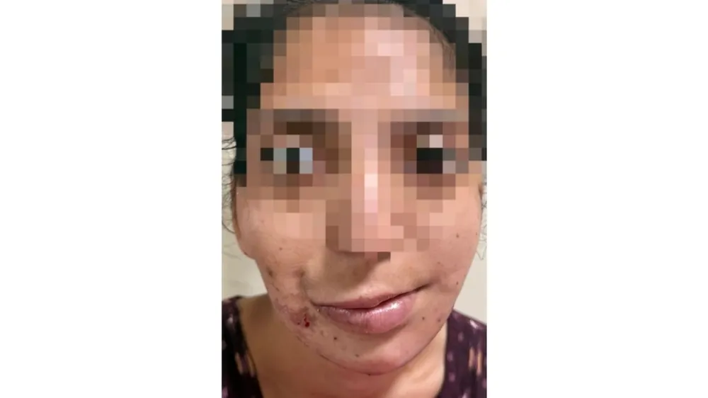 After surgery