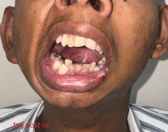 After surgery