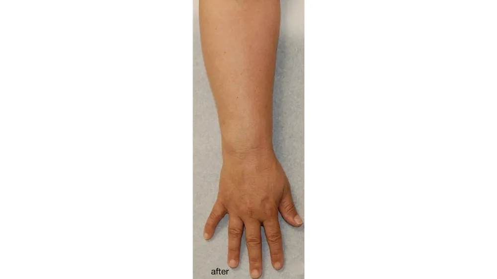 Post Cancer Lymphoedema — after
