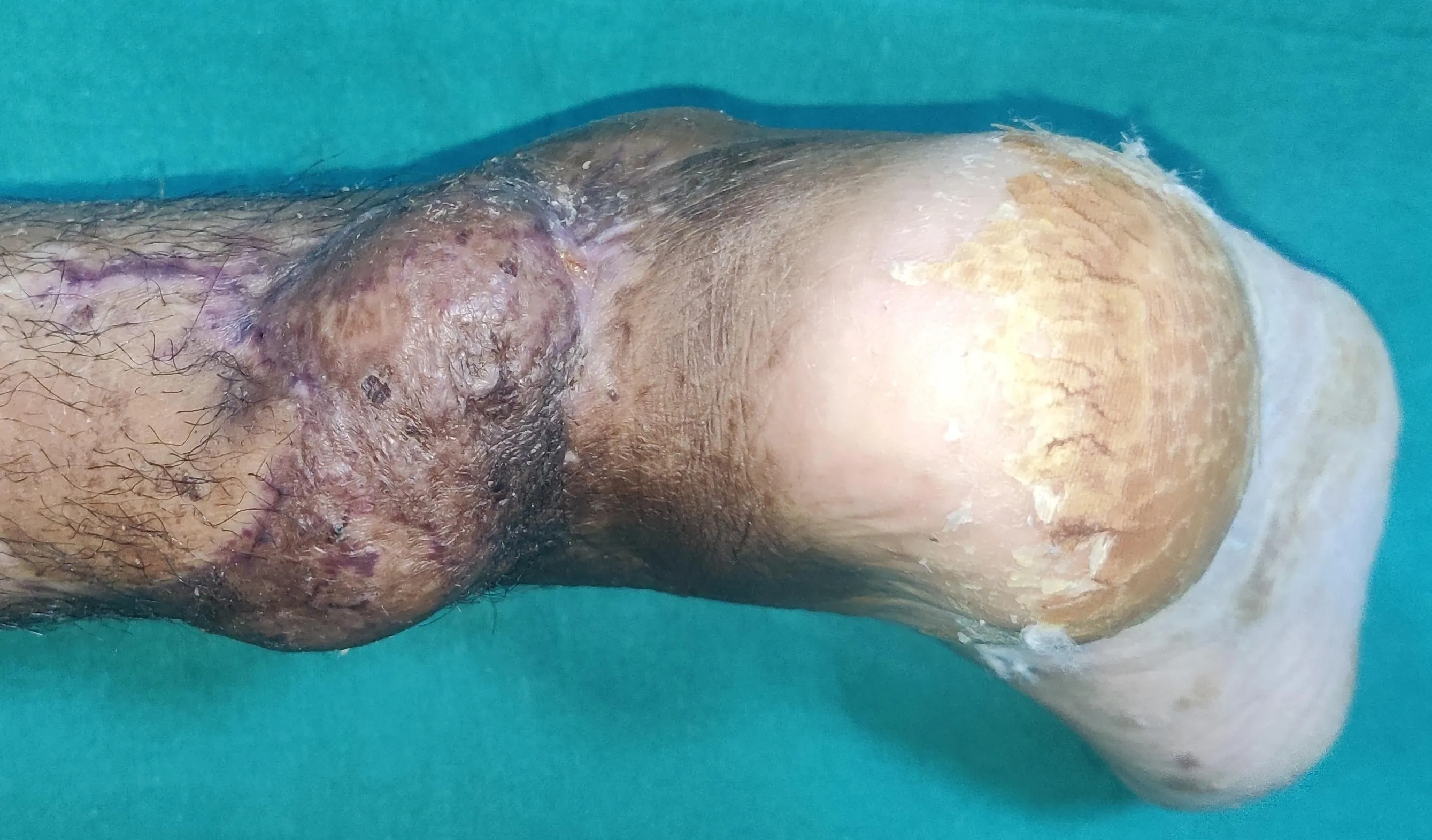 After surgery