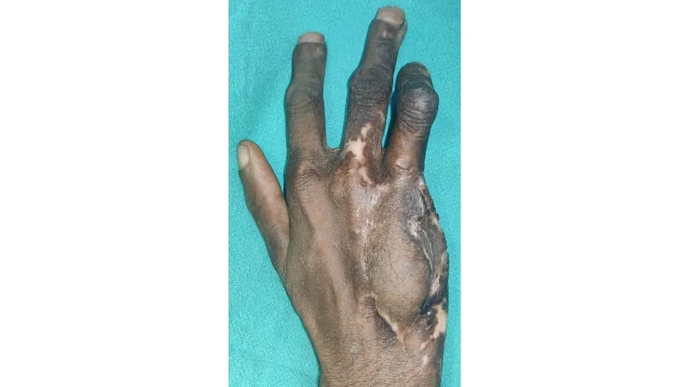 After surgery
