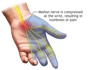 Nerve Injuries — hero image