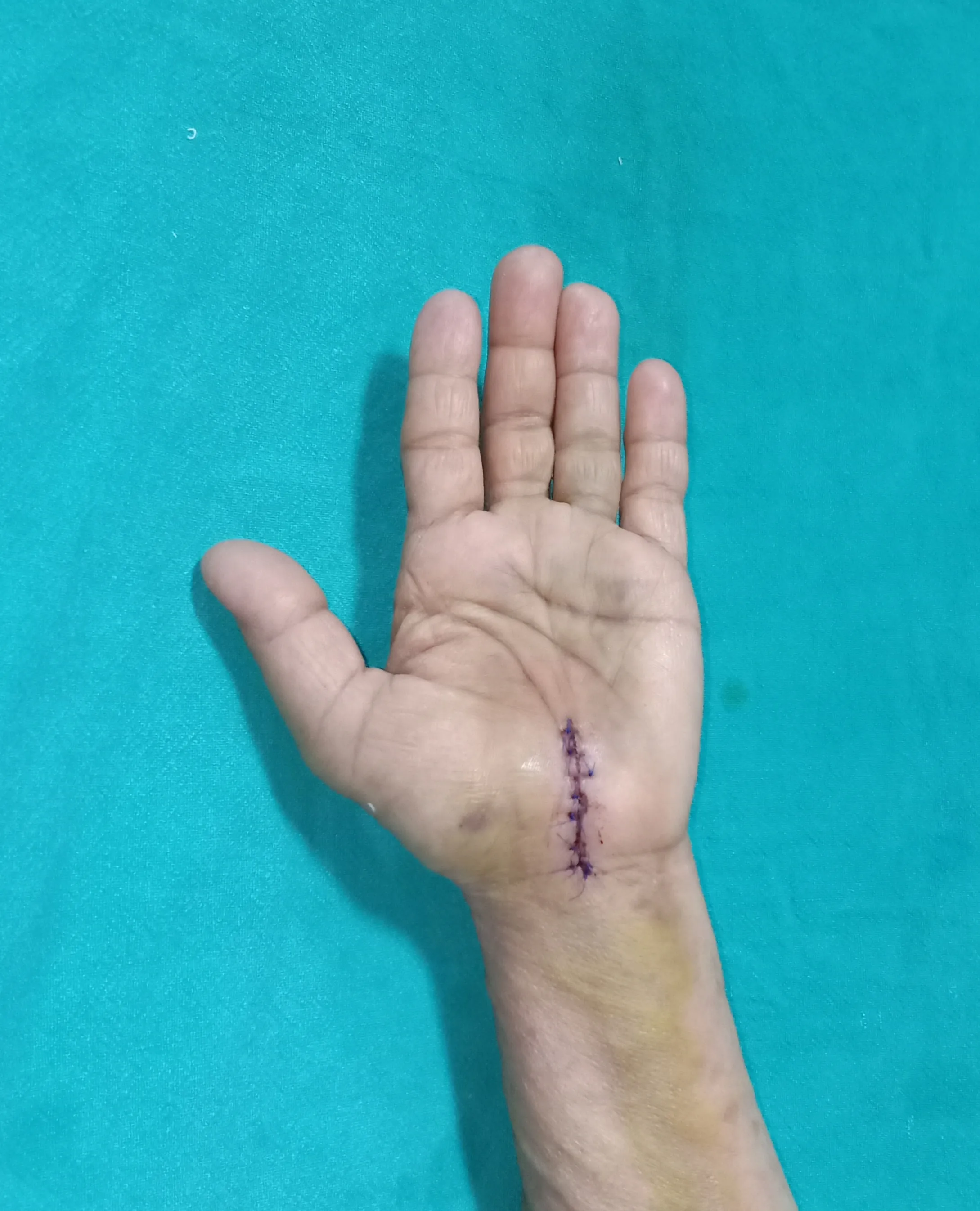After surgery