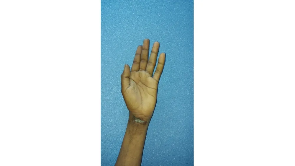 Hand Nerve Injuries — before