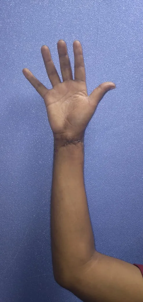 Hand Nerve Injuries — before