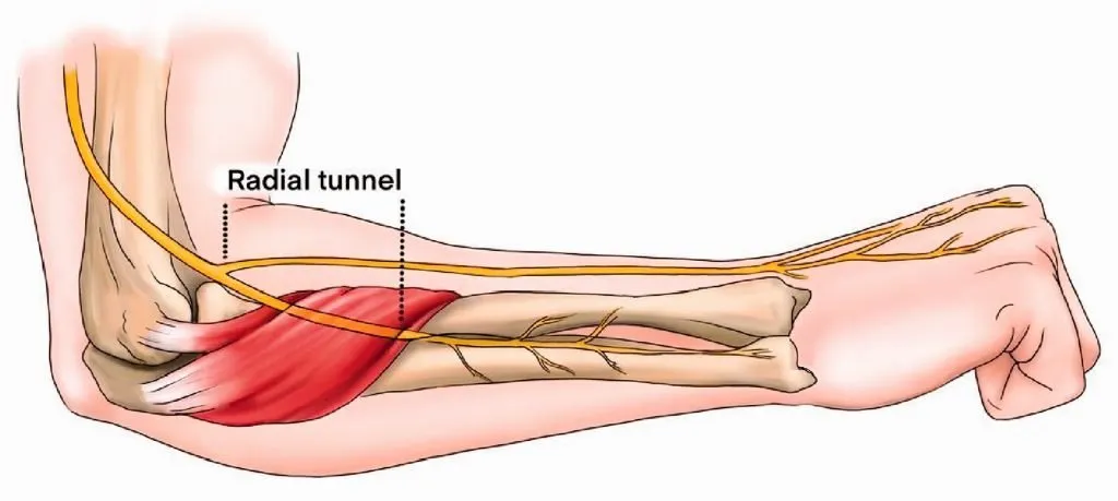 Understanding Resistant Tennis Elbow