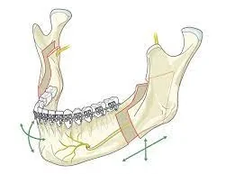 Bilateral Sagittal Split Osteotomy (BSSO) — hero image