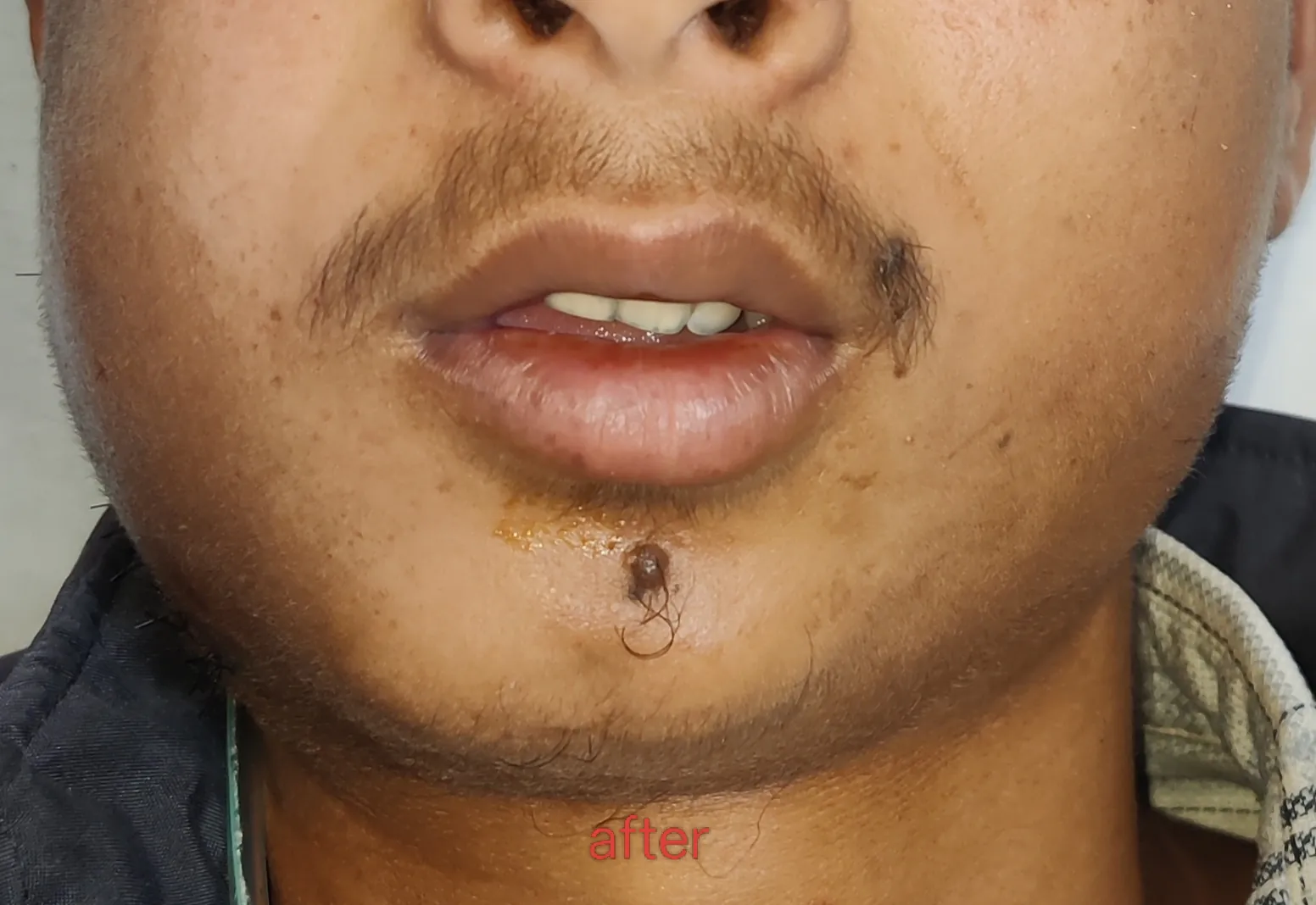 After surgery