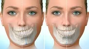 Craniofacial Microsomia (CFM) — hero image