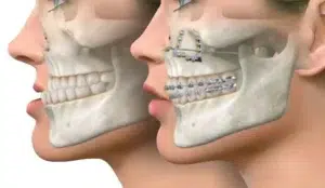 LeFort Osteotomy — hero image
