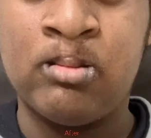Lefort Osteotomy — after