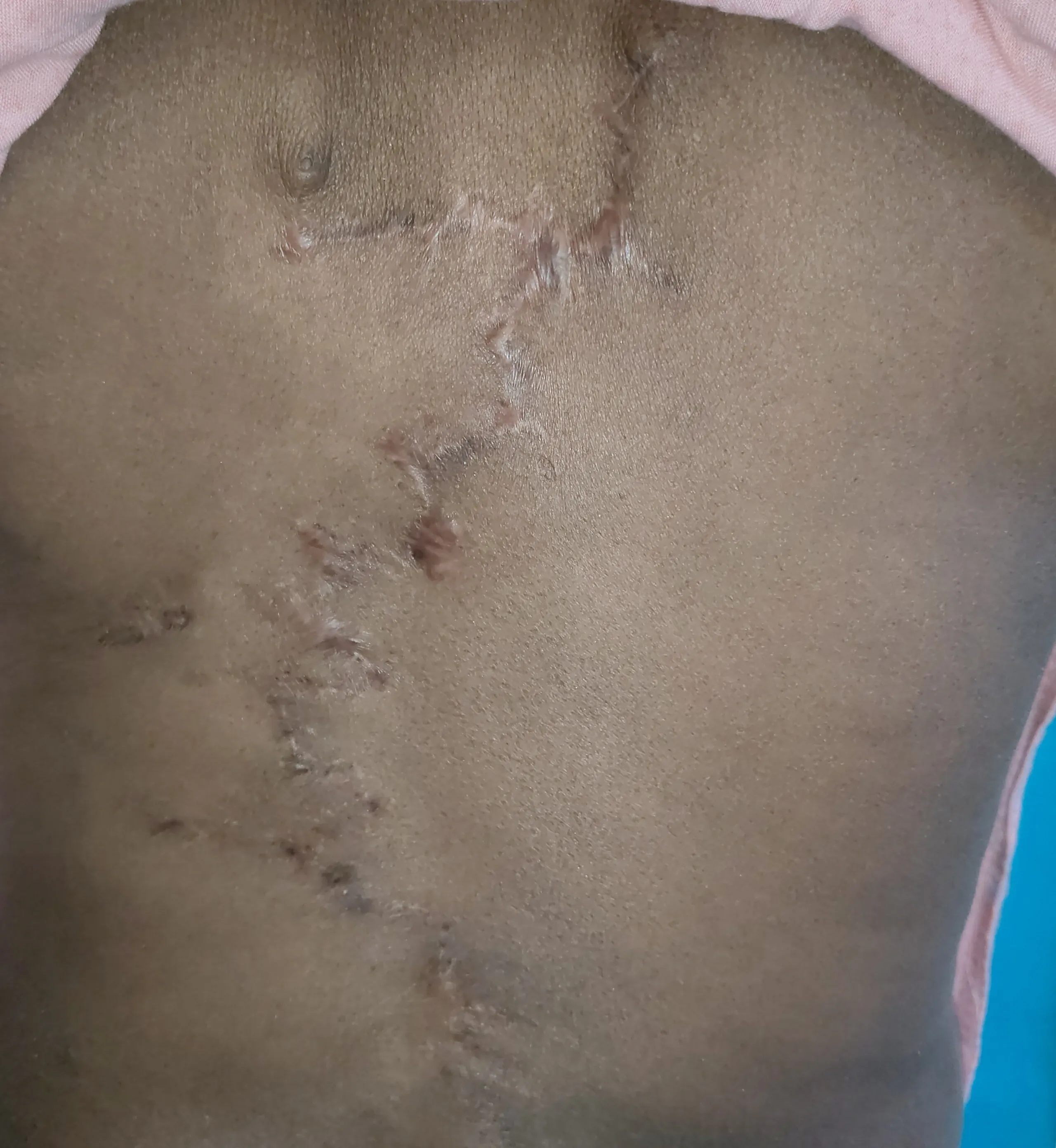 After surgery