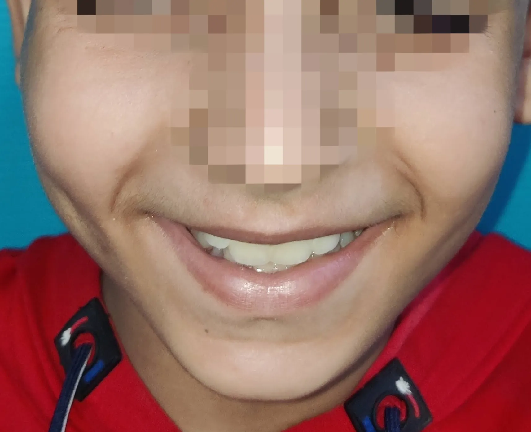 After surgery