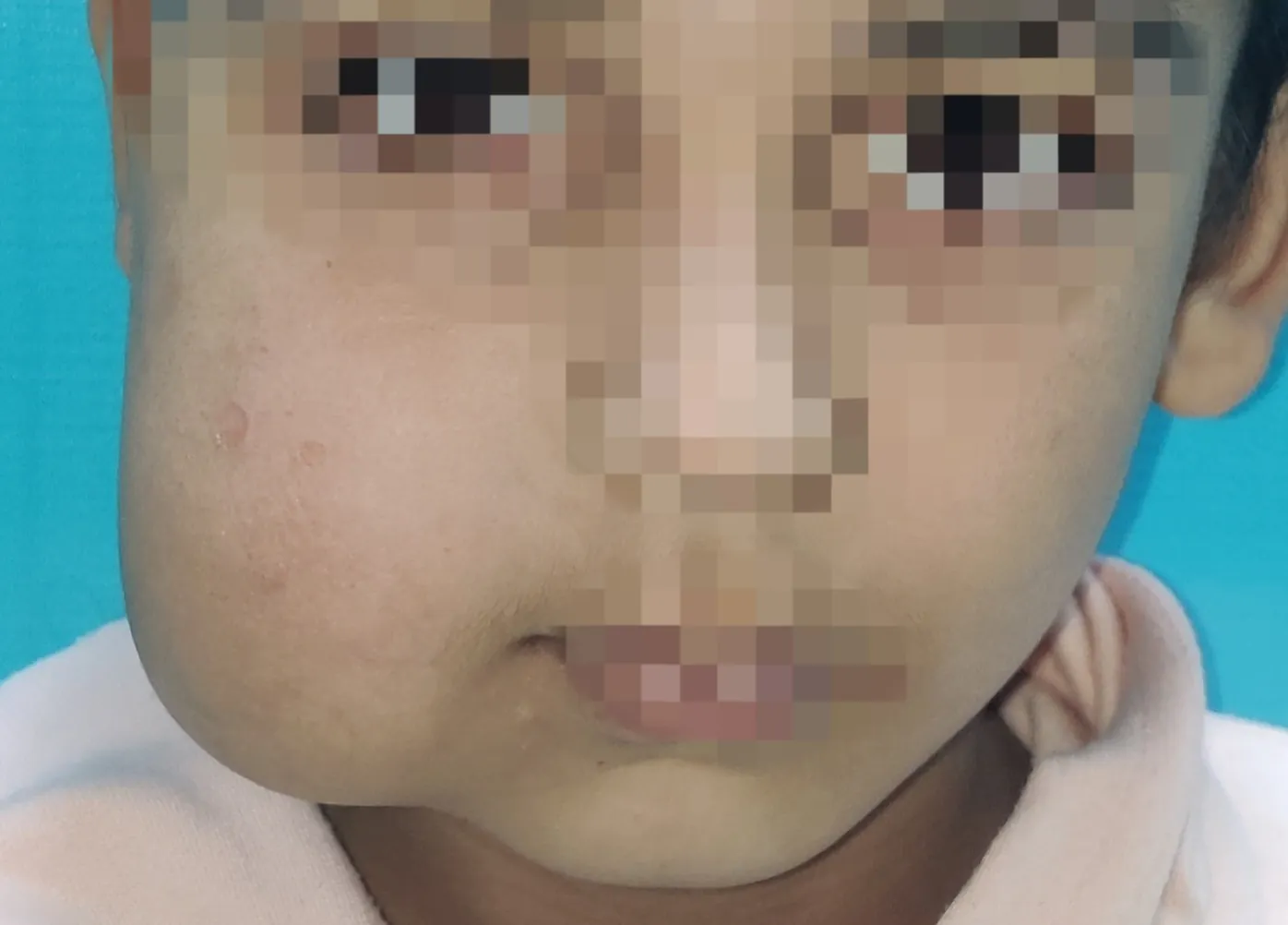 Before surgery