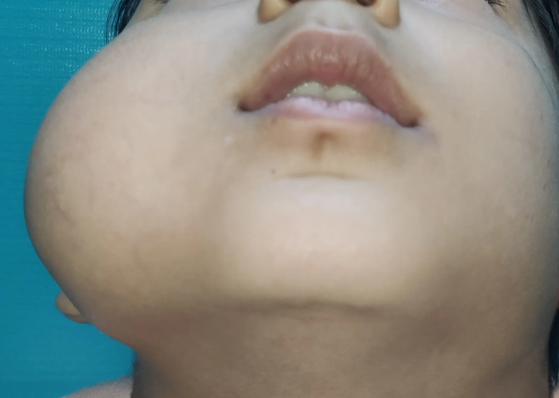 Before surgery