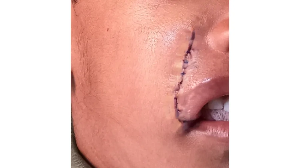 After surgery
