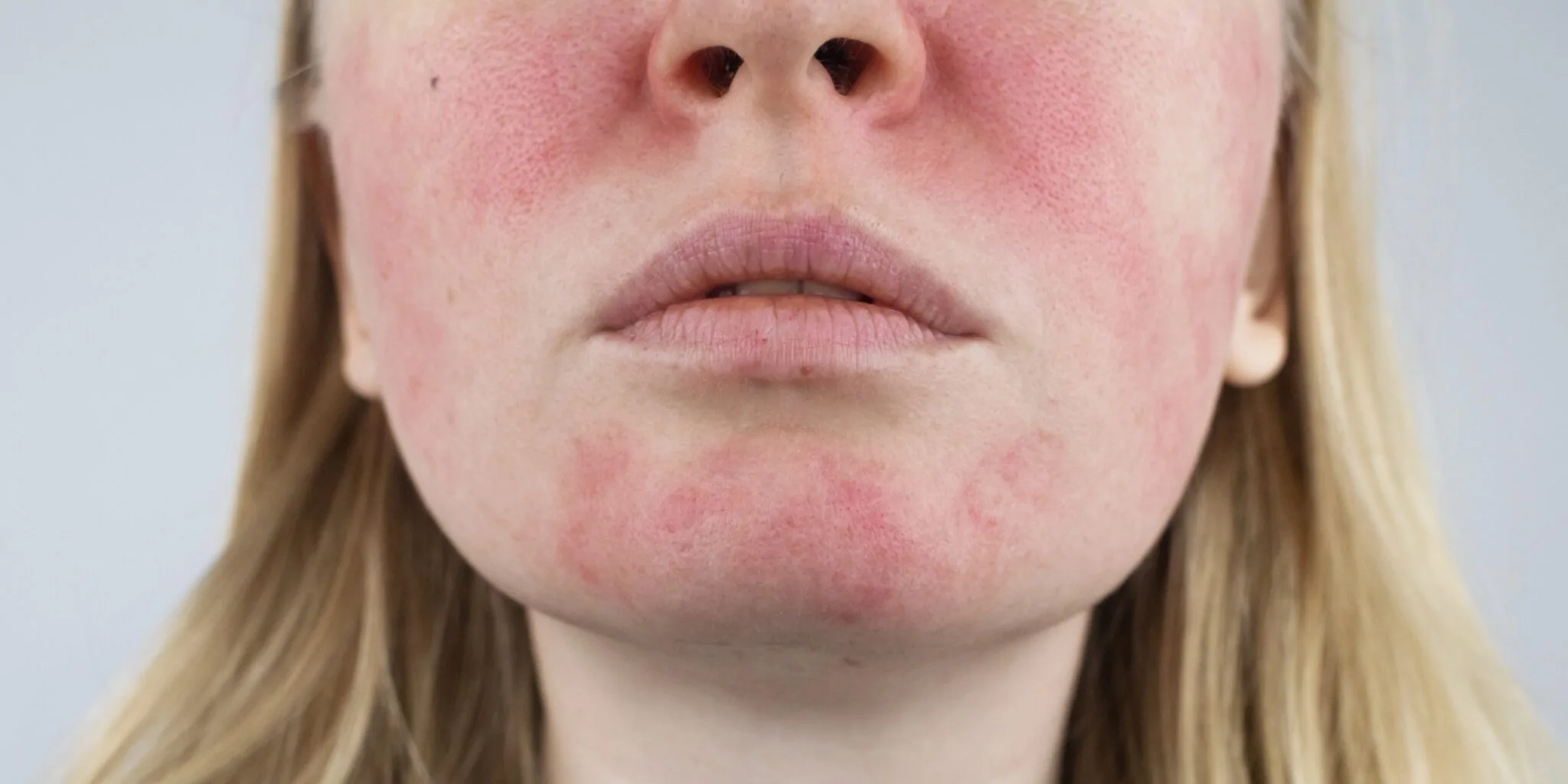 High-Flow Vascular Malformations — hero image