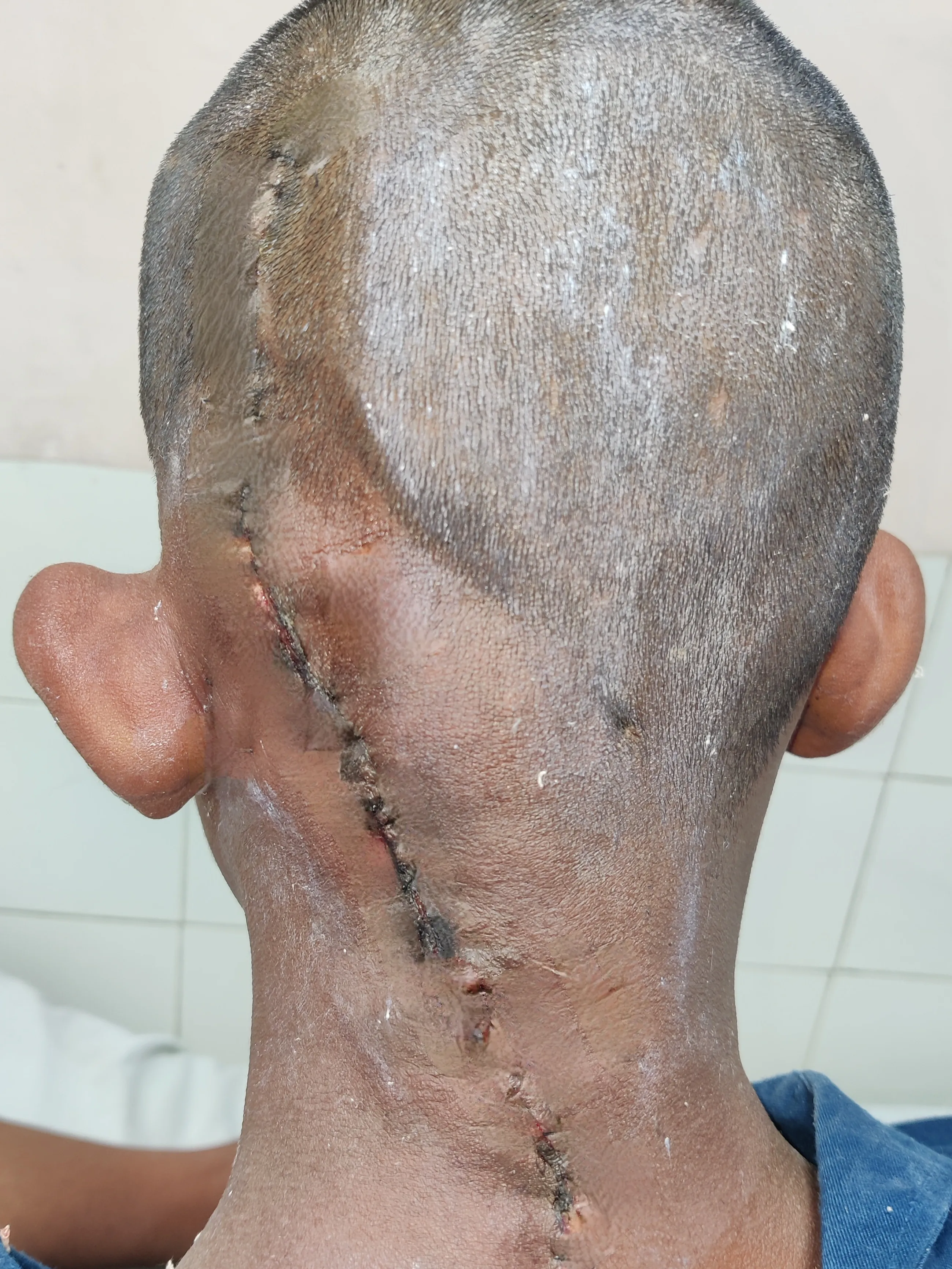 After surgery