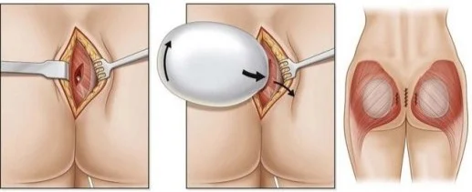 Butt Augmentation