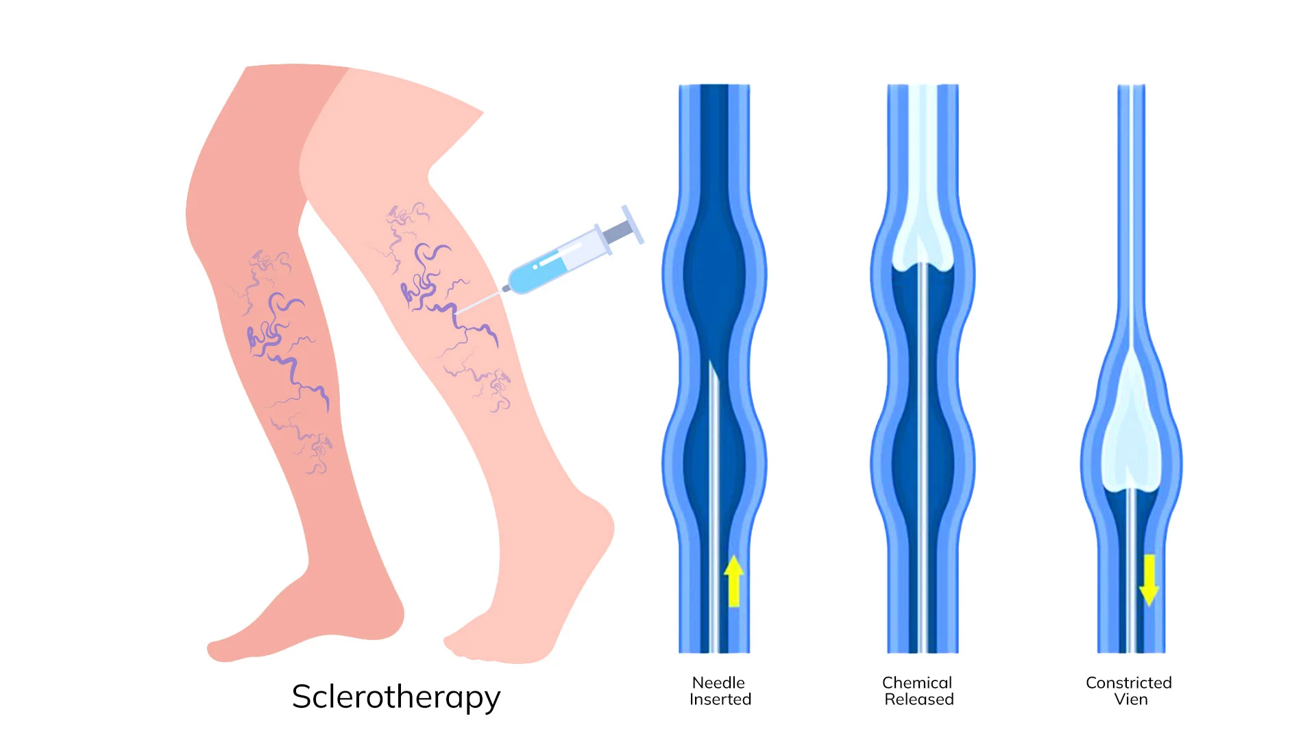 Spider Vein Treatment