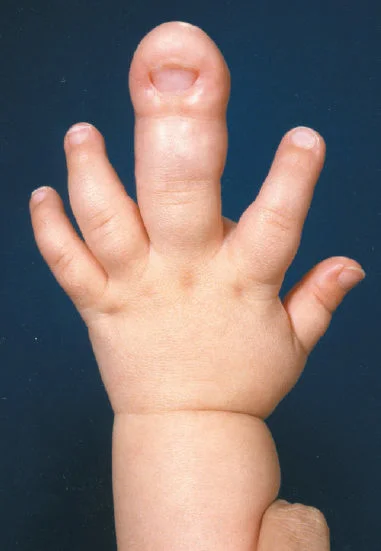 Macrodactyly (Overgrowth of Finger)