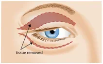 Blepharoplasty – Eyelid Surgery