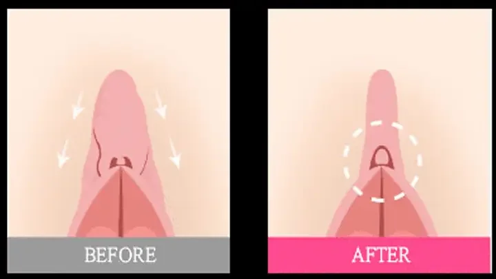 Clitoral Hood Reduction