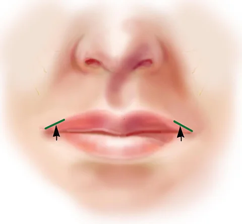 Upper Lip Lift