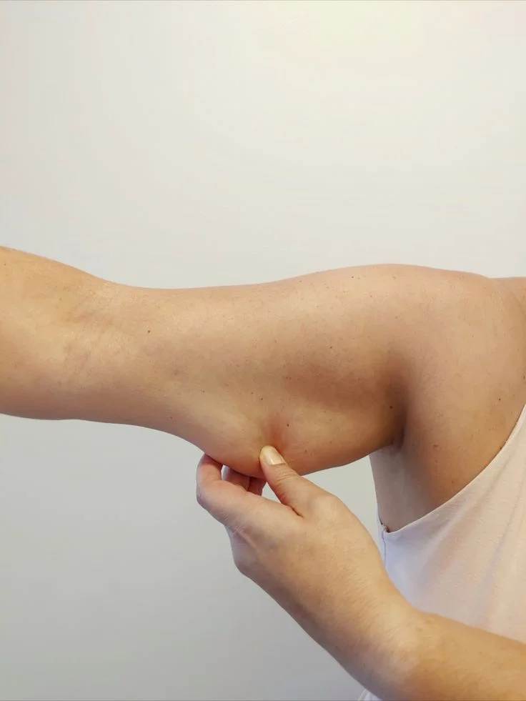 Liposuction of Arms