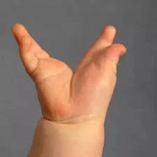 Cleft Hand/Foot