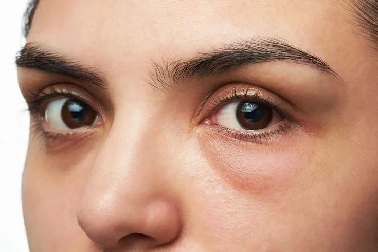 Blepharoplasty – Eyelid Surgery