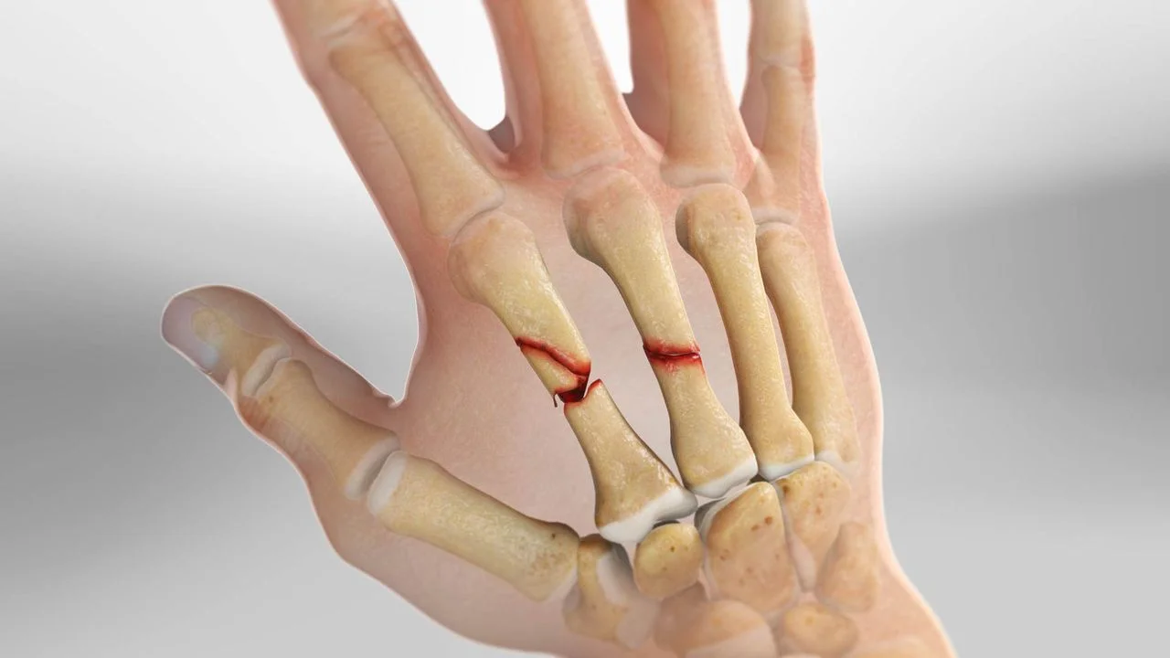 Hand Fracture