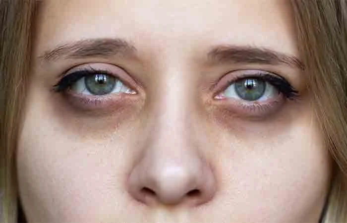 Dark Circles Treatment