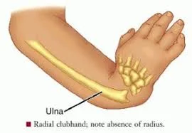 Radial Club Hand