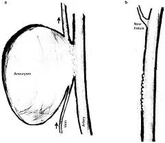 Complication of AV Fistula