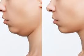 Double Chin Correction