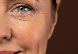 Correction of Facial Wrinkles