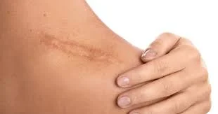 Scar Revision