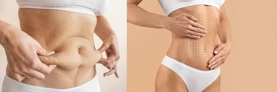 Mommy Makeover