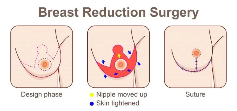 Breast Reduction