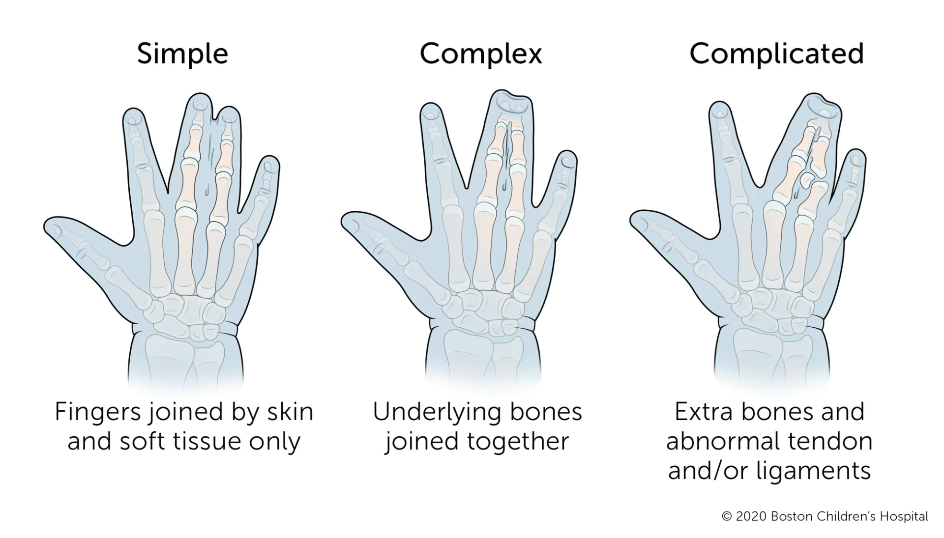 Syndactyly (Joined fingers)