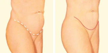 Tummy Tuck