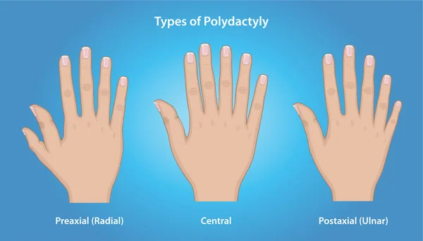 Polydactyly (Extra Fingers in Children)