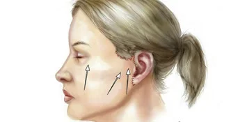 Face Lift