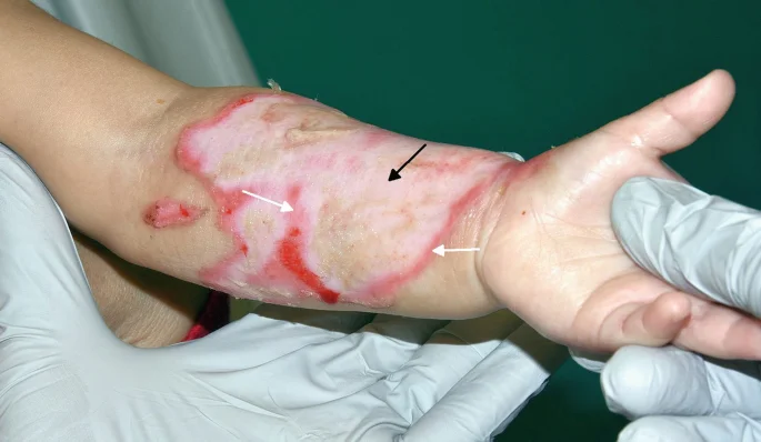 Burn White Patch/ Keloid Scar